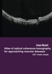 Atlas of Optical Coherence Tomography for Approaching Macular Diseases OCT Made Simple