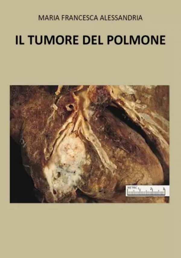 Il tumore nel polmone di Maria Francesca Alessandria