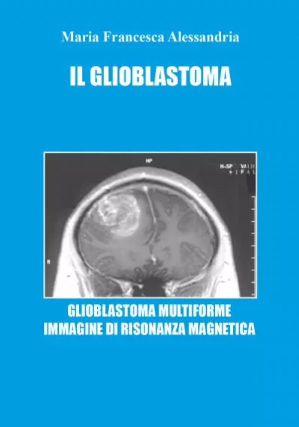 Il Glioblastoma di Maria Francesca Alessandria